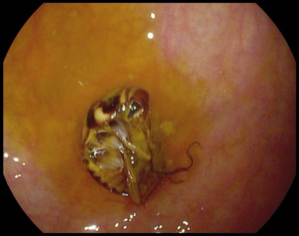 a mangled cockroach can be seen stuck to someone's intestine